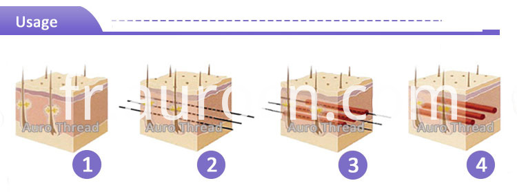Levage de fil Thread Lifting